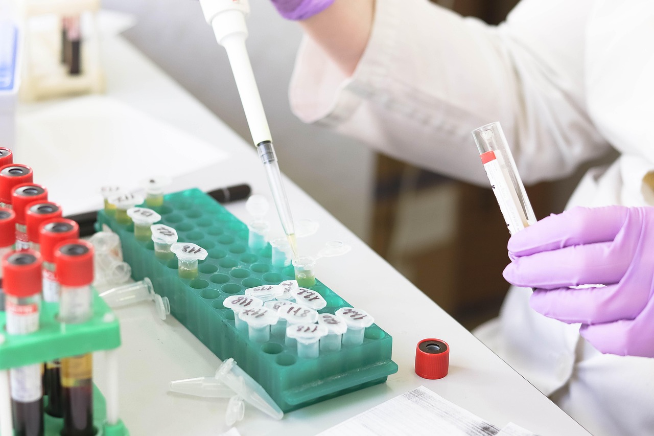 Blood test in laboratory to check uric acid levels