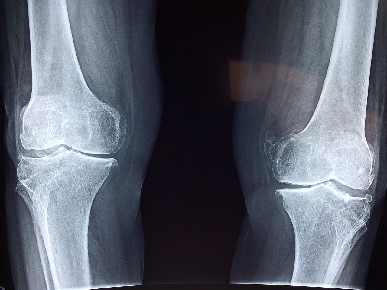 A medical knee brace or examination setting for knee pain