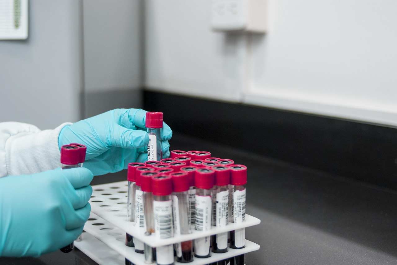 Uric acid blood test in a medical laboratory